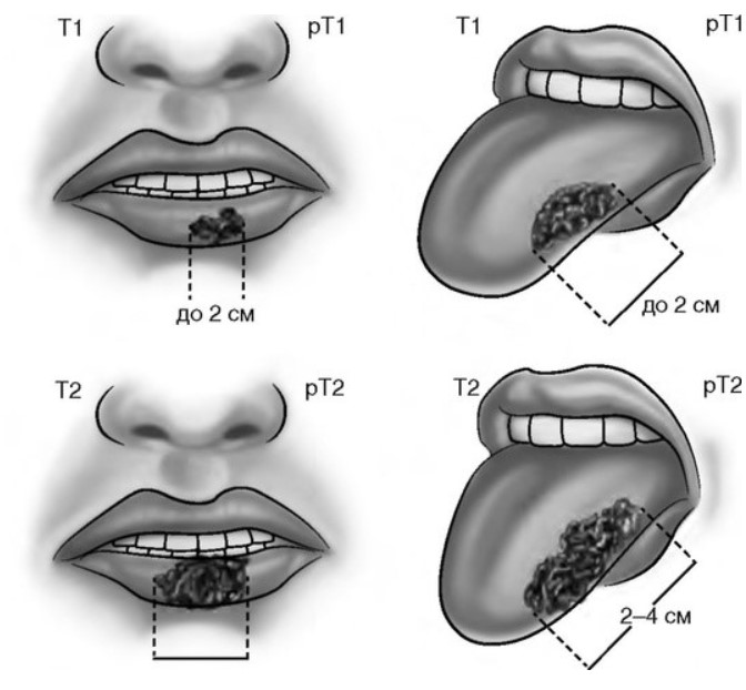 4 рта 4 уха. Новообразование на нижней губе. Злокачественное новообразование губы.