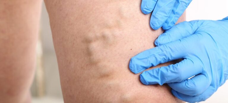 Профилактика варикозной болезни